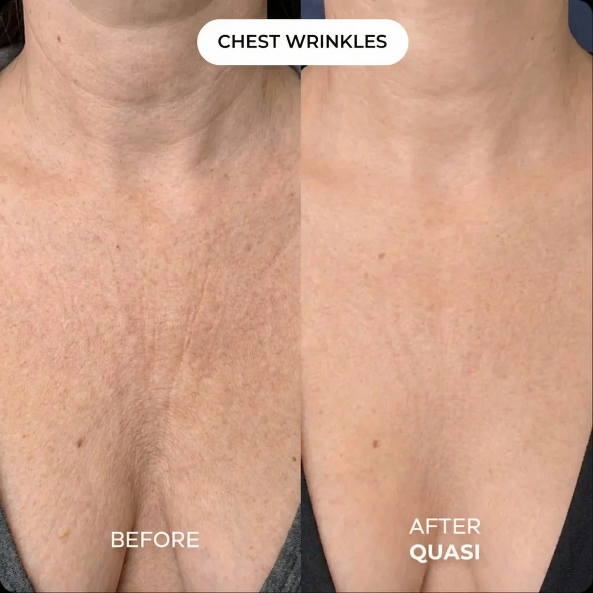 Collagen Chest Mask (free gift)